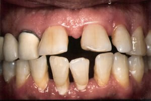 Advanced periodontal disease - before